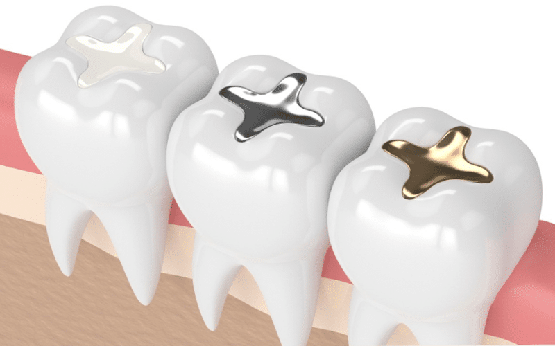 Poor oral hygiene leads to Dental Fillings