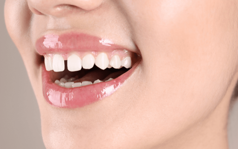 How to fix gap in your teeth