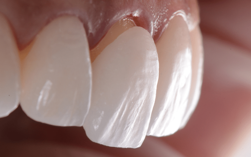 Porcelain veneers for global beauty standards