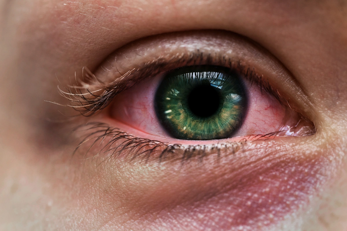Featured image for “Can You Go to Work with Pink Eye? What You Need to Know”