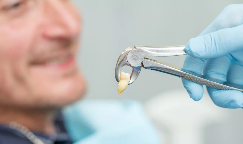 wisdom teeth removal