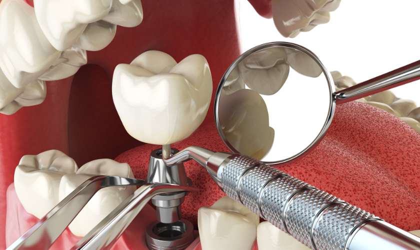 Dental Implant in Colleyville TX, Serene Dental of Colleyville
