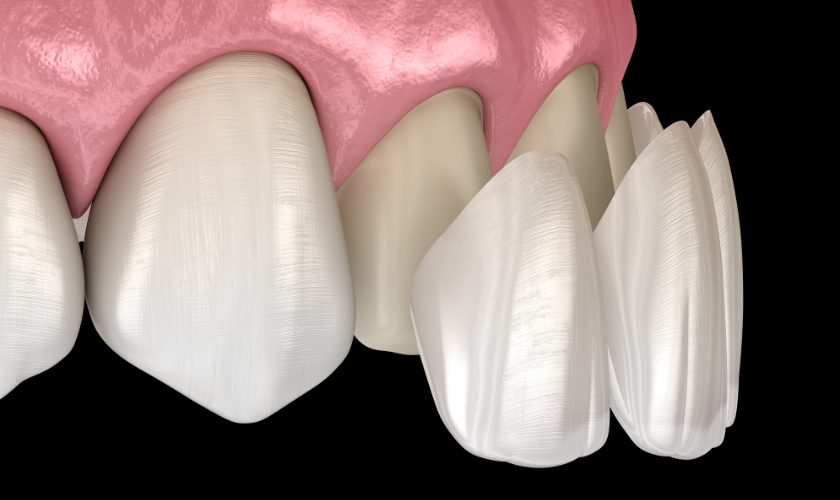 Porcelain Veneers in Colleyville TX, Serene Dental of Colleyville, Dentist, Dentist in Colleyville TX,