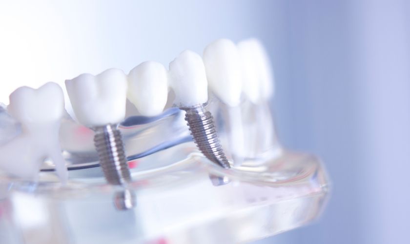 Dental Implants Colleyville - Serene Dental of Colleyville