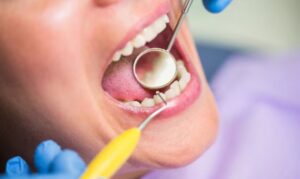 Sealants In Serene Dental of Colleyville TX