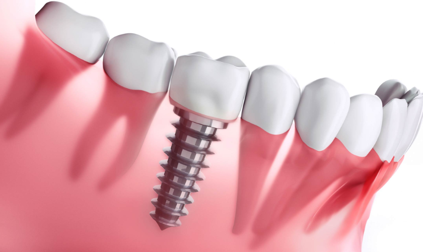dental implants (2)