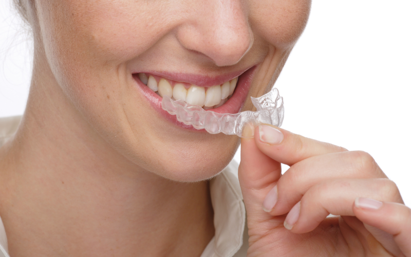 invisalign