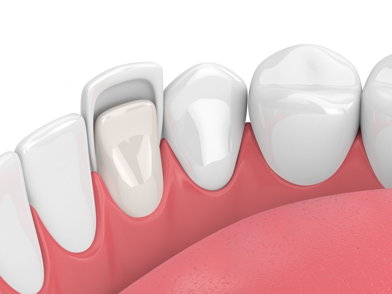 porcelain veneers in colleyville tx