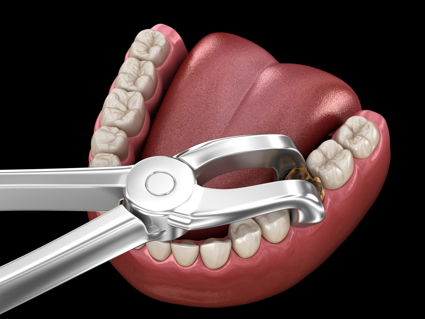 candidate for tooth extractions