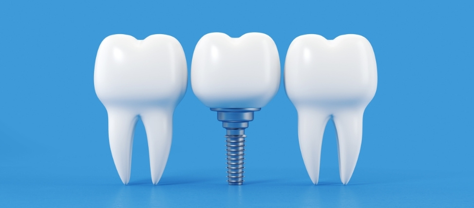 signs you might be a good candidate for dental implants