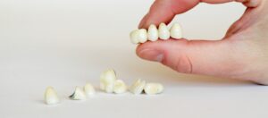 How Long Does A Dental Bridge Usually Last