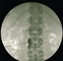 Sympathetic Nerve Blocks