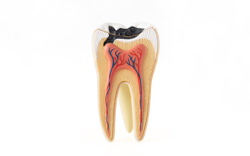 root canal recovery