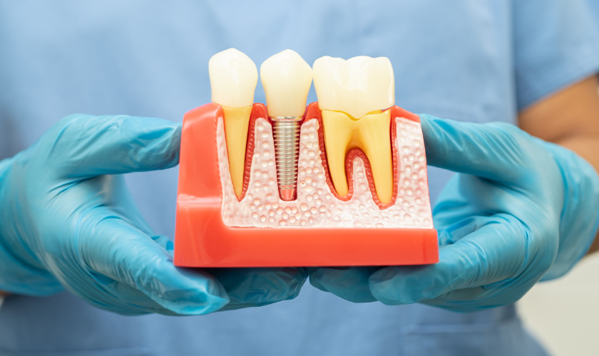 Understanding Dental Implants- Your Complete Guide to Tooth Replacement