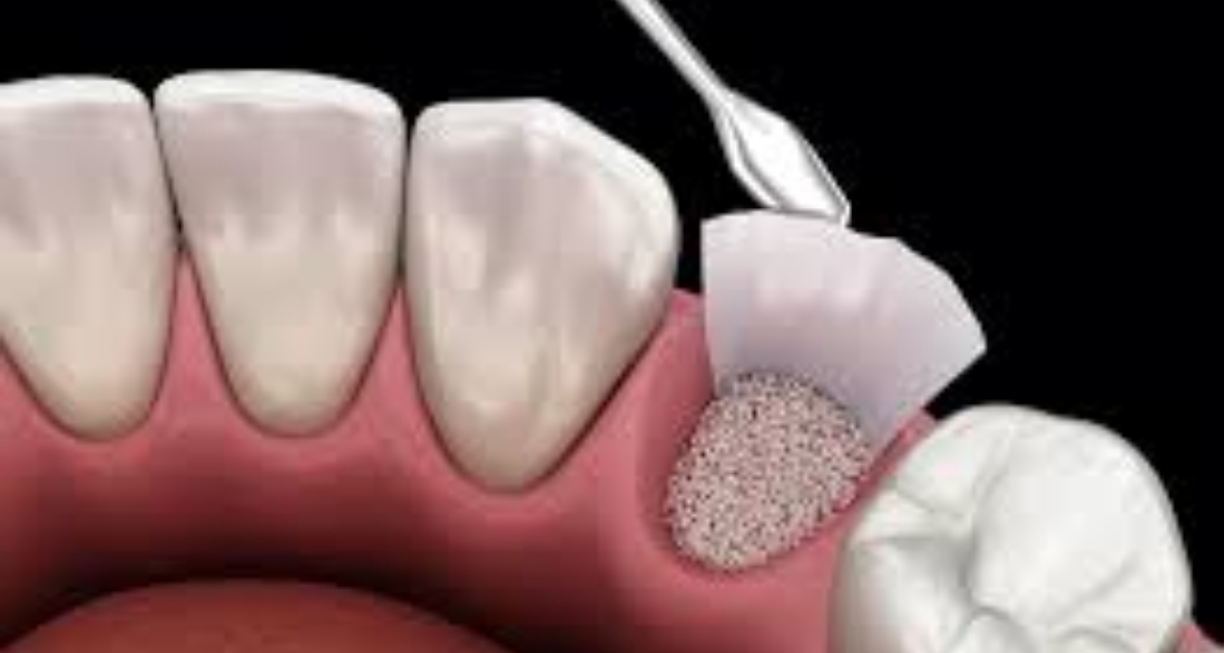 why is bone grafting after tooth loss essential for your oral health