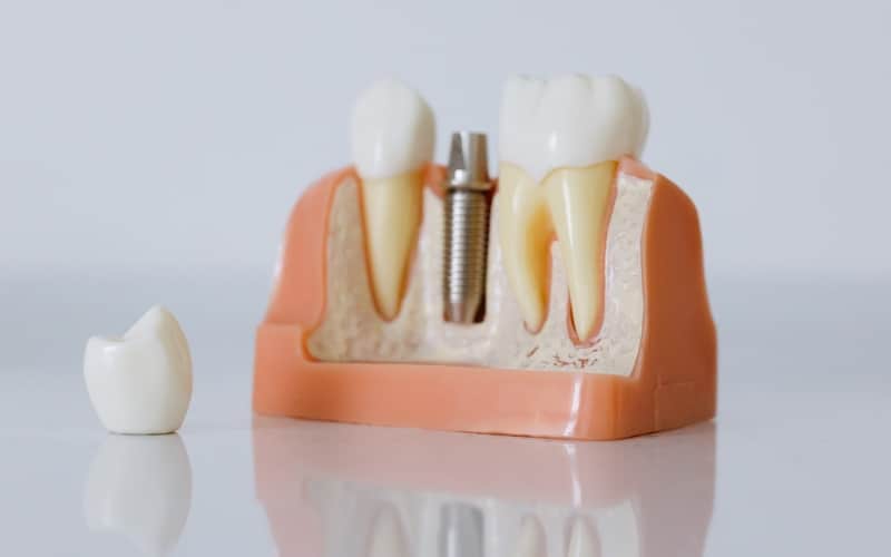 dental implants pain