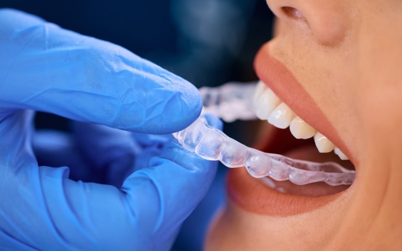 invisalign fix gaps between teeth