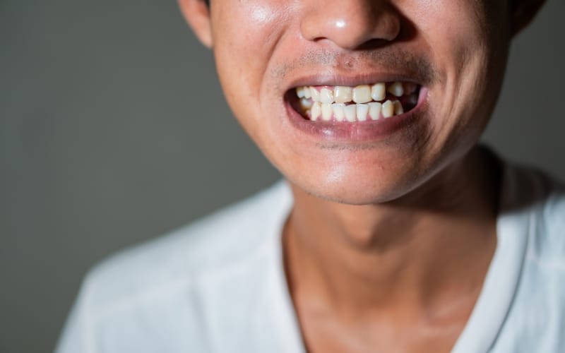 Gum Recession