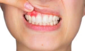 Gum Disease