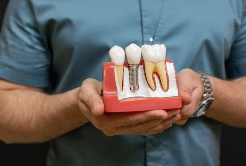 Top Tips for Increasing the Longevity of Dental Implants